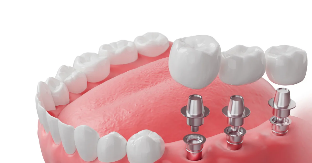 Zirconia Dental Implants Pros and Cons