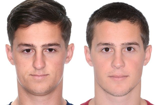 Maxillomandibular Advancement with Genioplasty