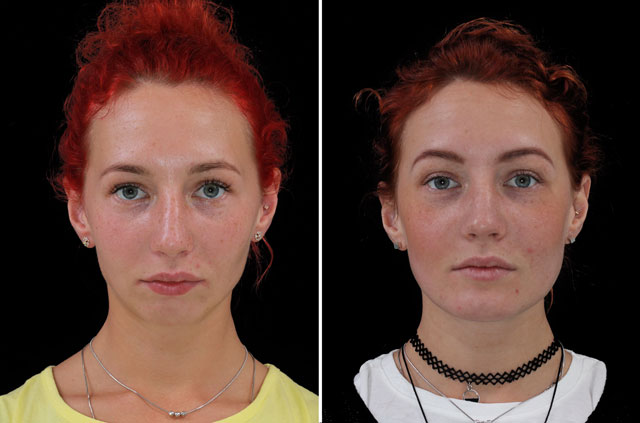 Correction Of Class II Malocclusion
