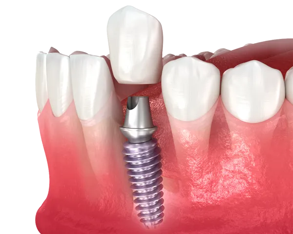 What Is Osseointegration? How Dental Implants Fuse With Your Jawbone