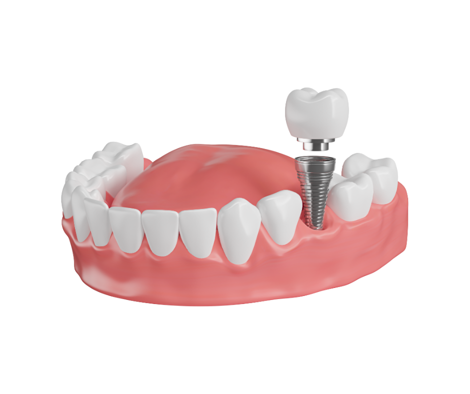 Dental implant procedure