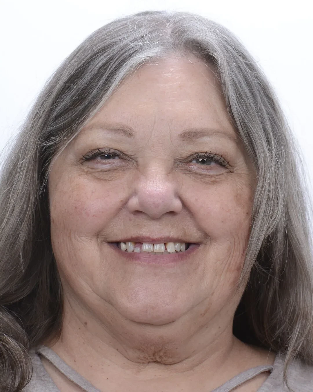 Patient before dental implant transformation at Fusion Dental Implants Roseville CA