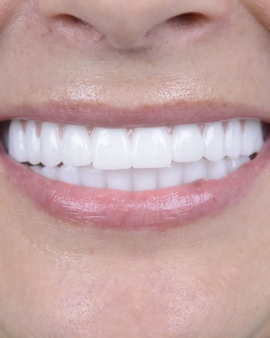 Close-up of teeth after dental implant treatment showing restored smile