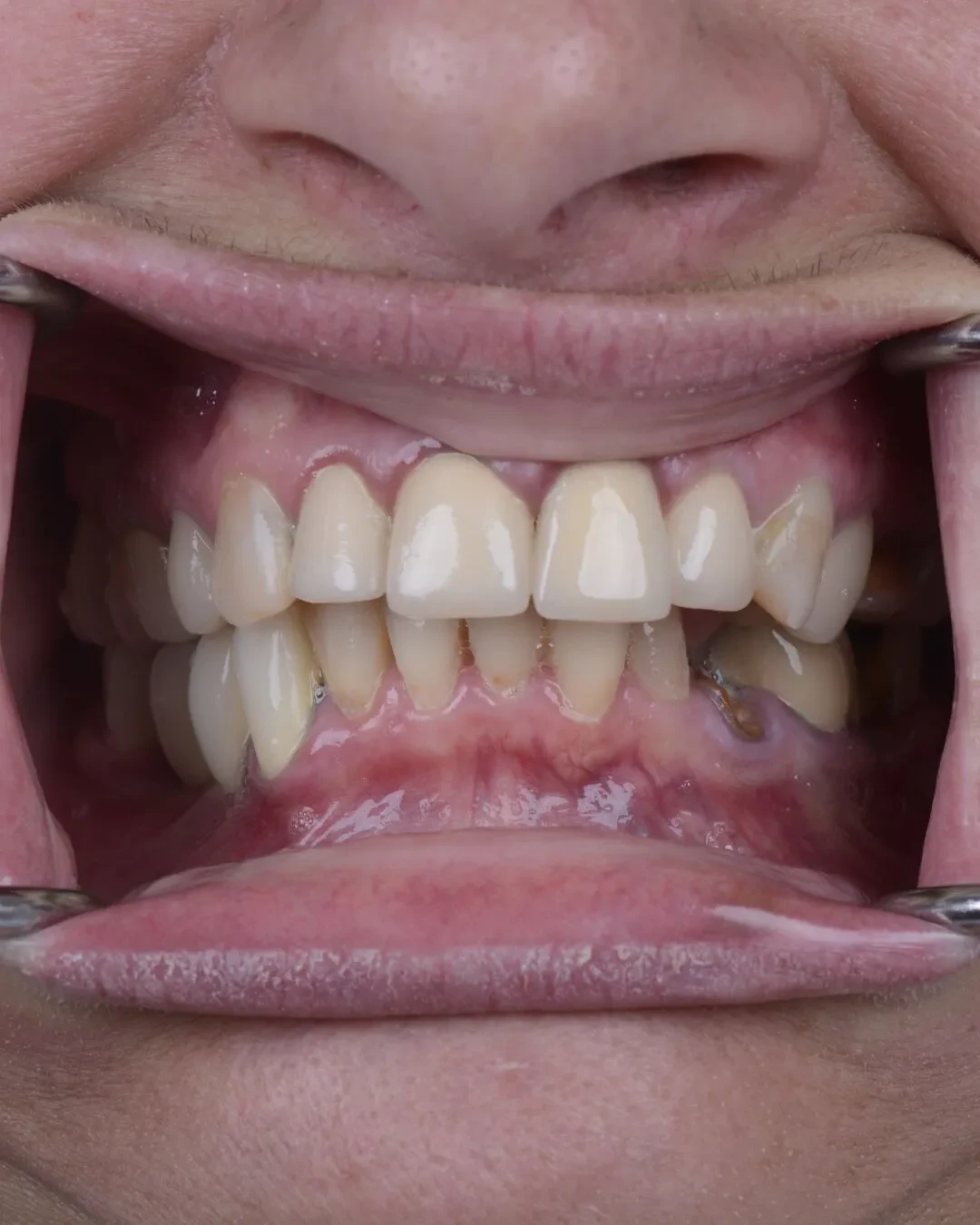 Close-up of teeth before dental implant treatment at Fusion Dental Implants