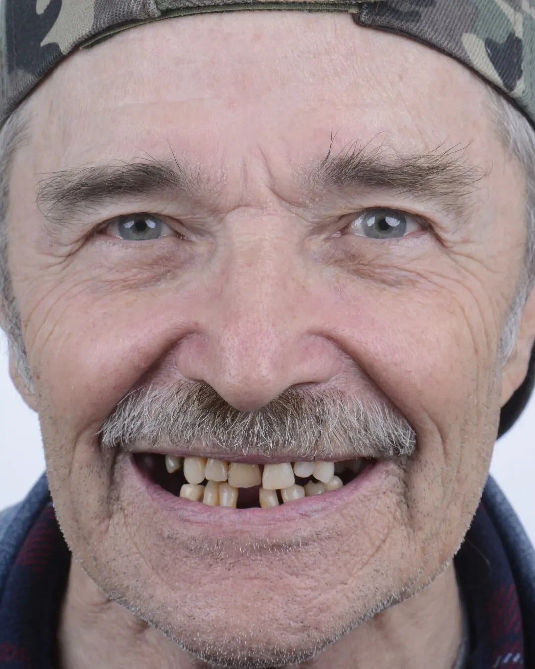 Patient 2 before dental implant procedure at Fusion Dental Implants Sacramento