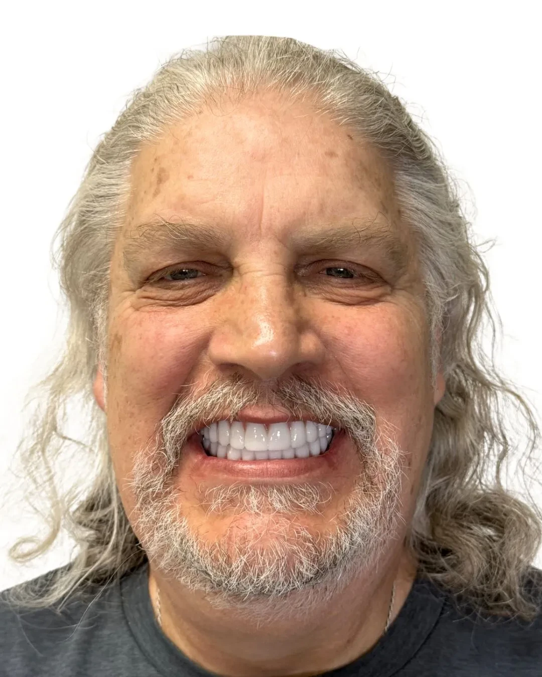 Patient 3 after full arch restoration with a confident new smile