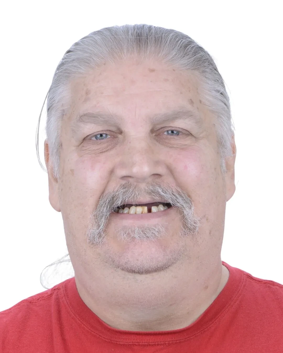 Patient 3 before full arch restoration at Fusion Dental Implants