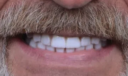 After teeth close-up - Dental implant transformation - life-changing results