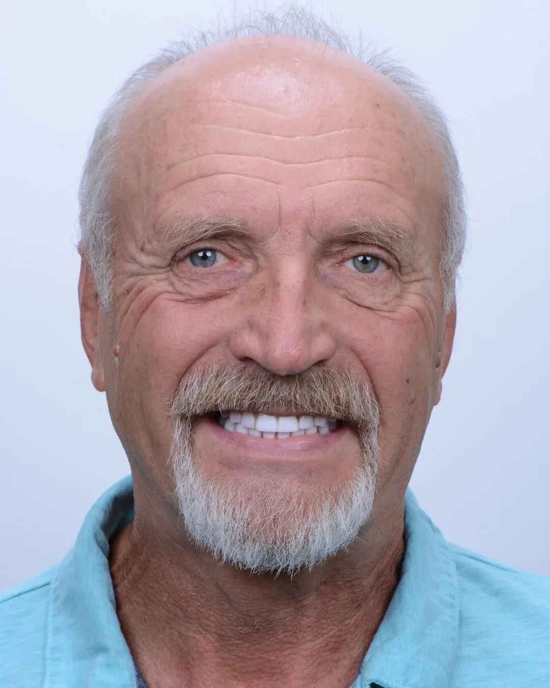 Patient 4 after dental implant treatment with dramatically improved smile