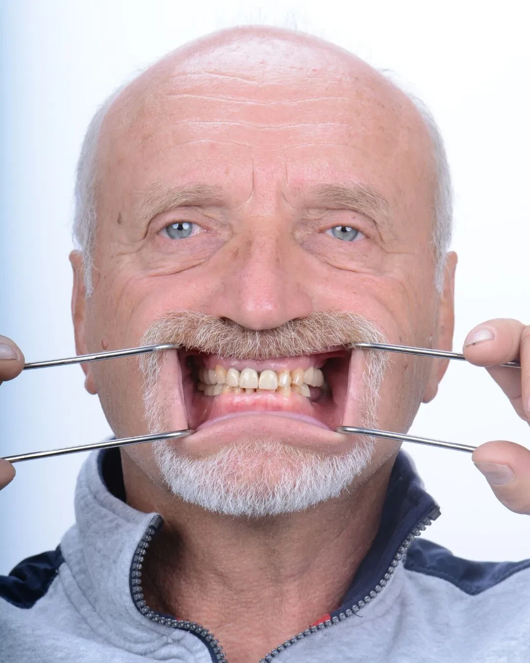 Patient 4 before dental implant treatment in Roseville California