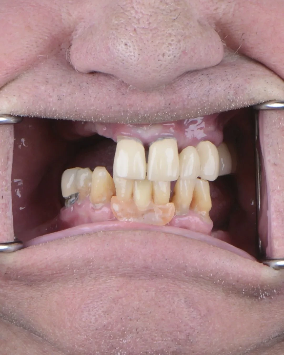 Close-up of patient 4 teeth before implant restoration