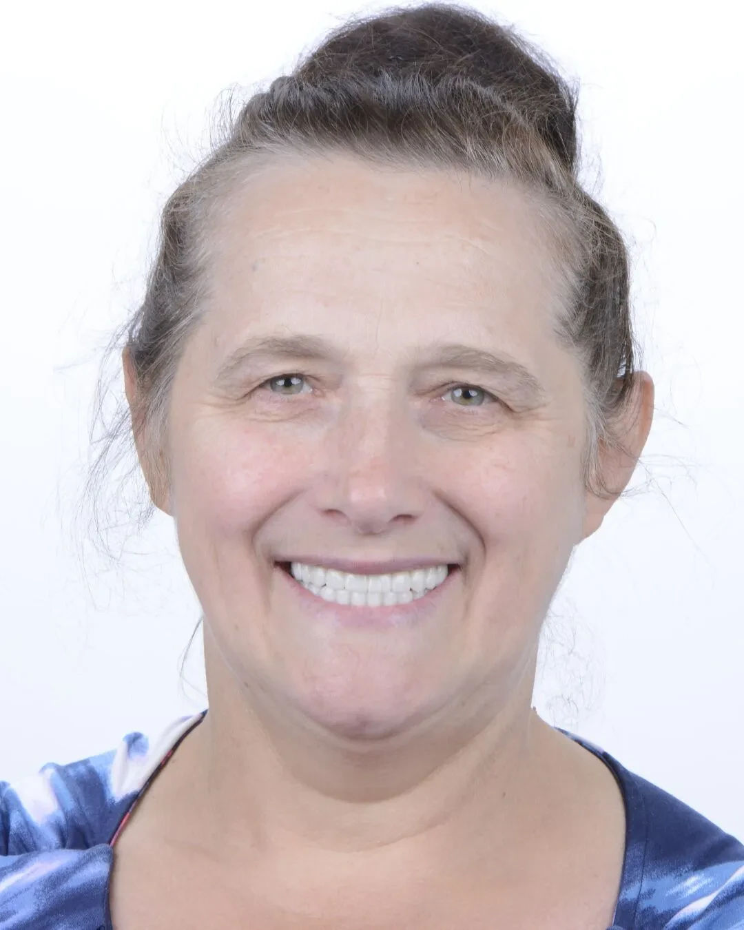 Patient 5 after smile makeover with beautiful dental implants