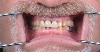 Before teeth close-up - Dental implant transformation - life-changing results
