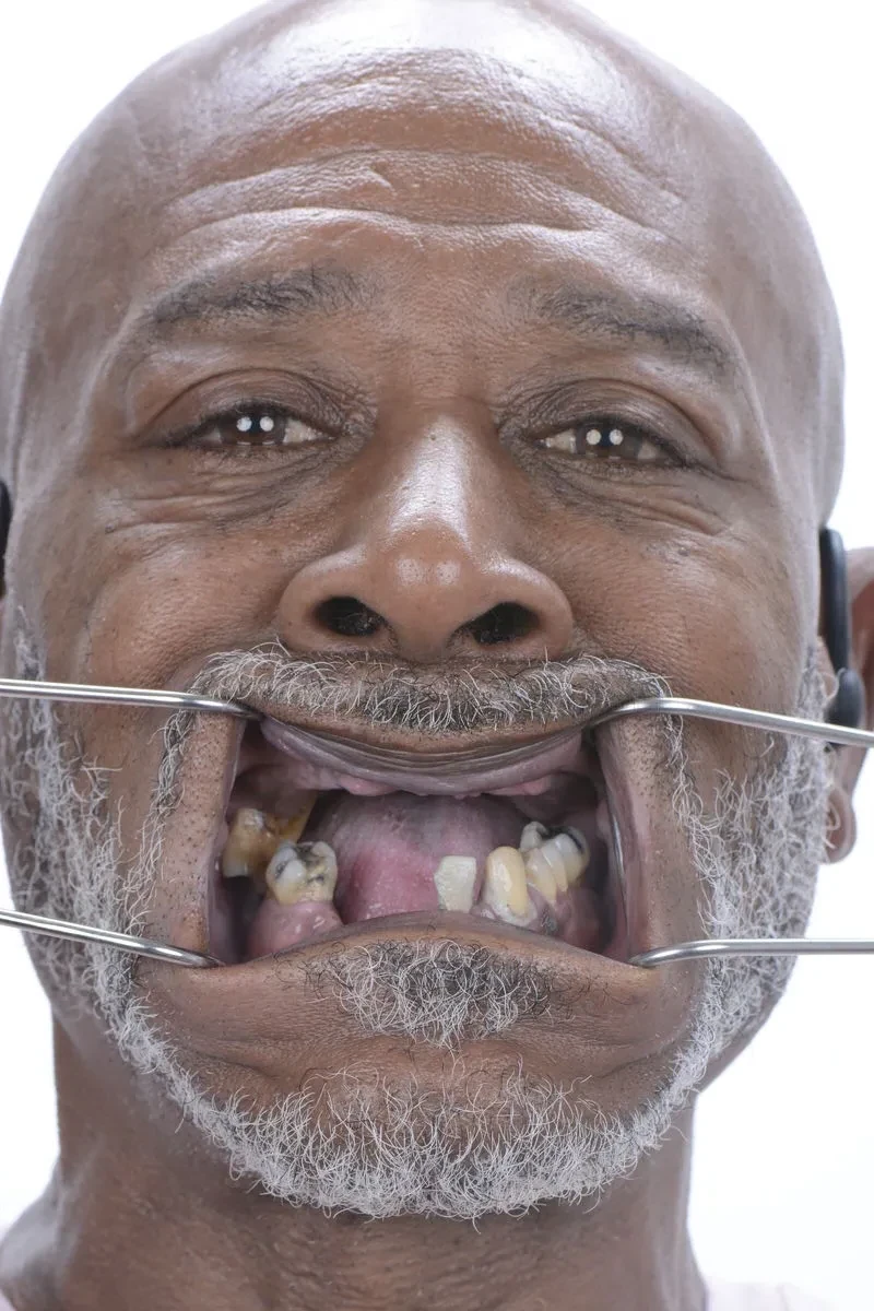 Patient 6 before dental restoration at Fusion Dental Implants Sacramento CA