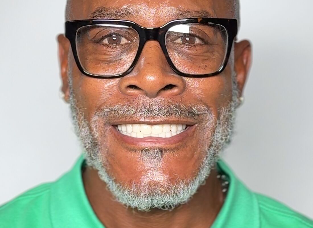 Patient 6 teeth close-up after treatment showing excellent results