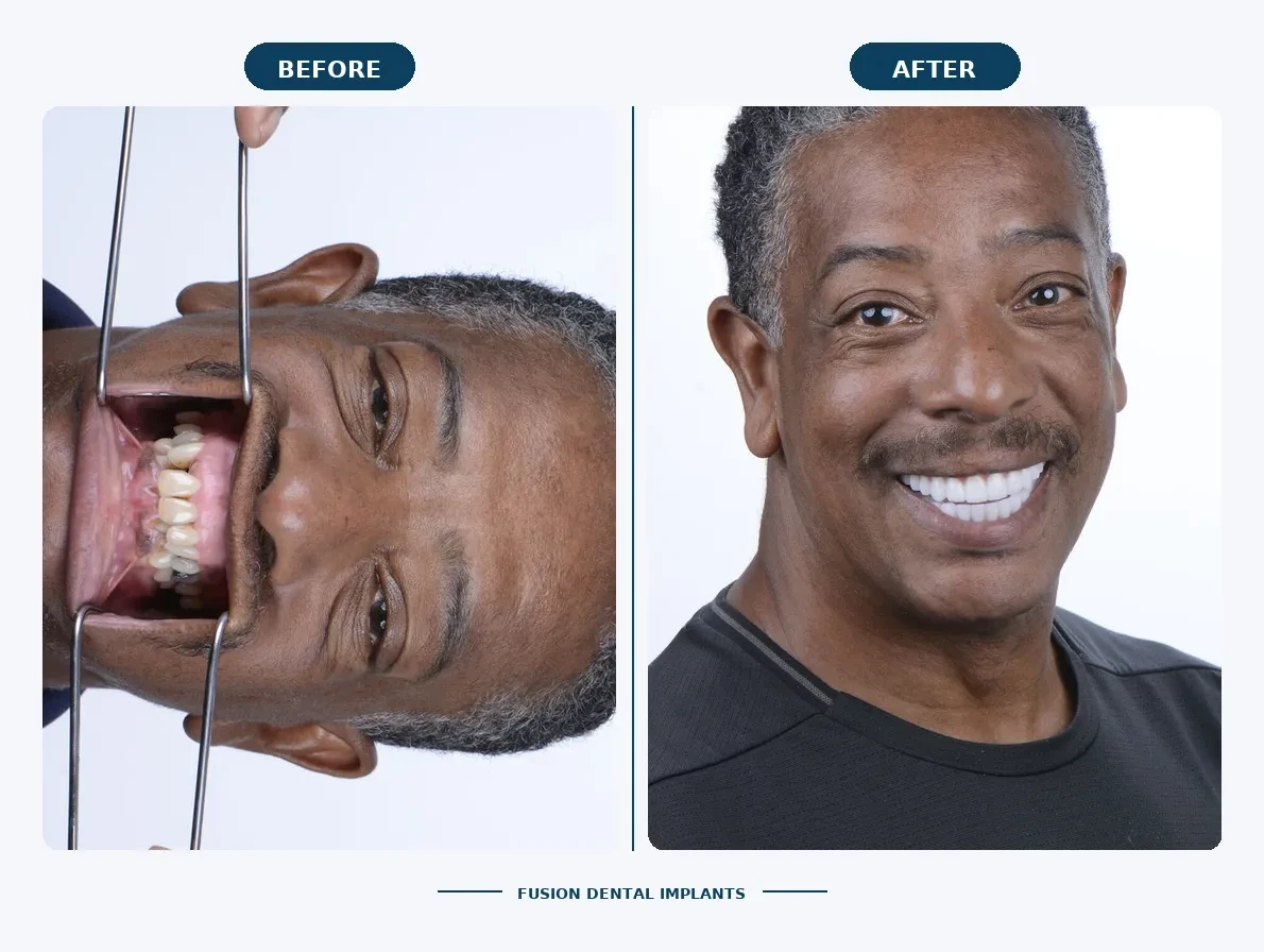 Before and After All-on-4 Dental Implants: Real Cases