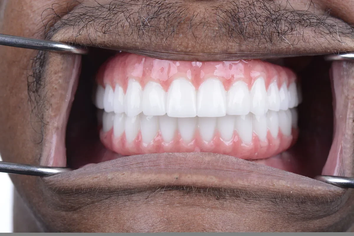 Patient 7 teeth after full mouth reconstruction