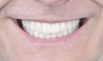 After teeth close-up - Dental implant transformation - confident new smile