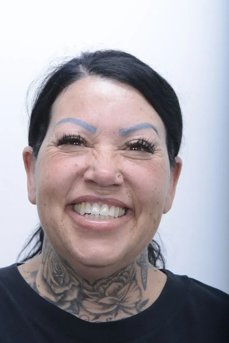 Patient 8 after dental implant surgery with a beautiful new smile