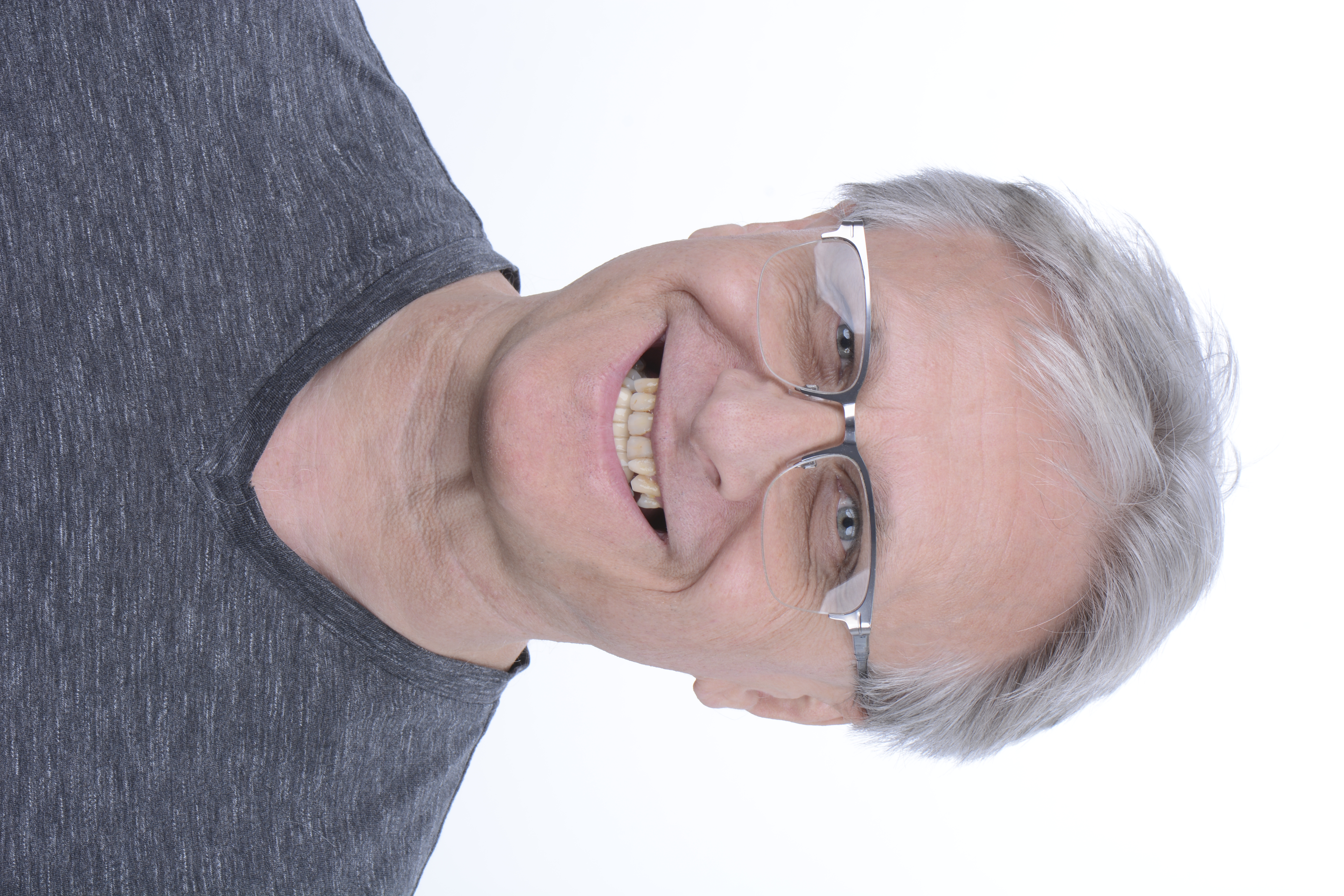 Before - Dental implant transformation - confident new smile