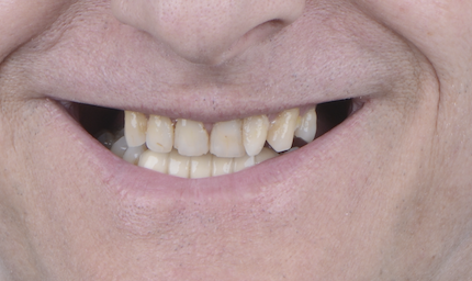 Before teeth close-up - Dental implant transformation - confident new smile
