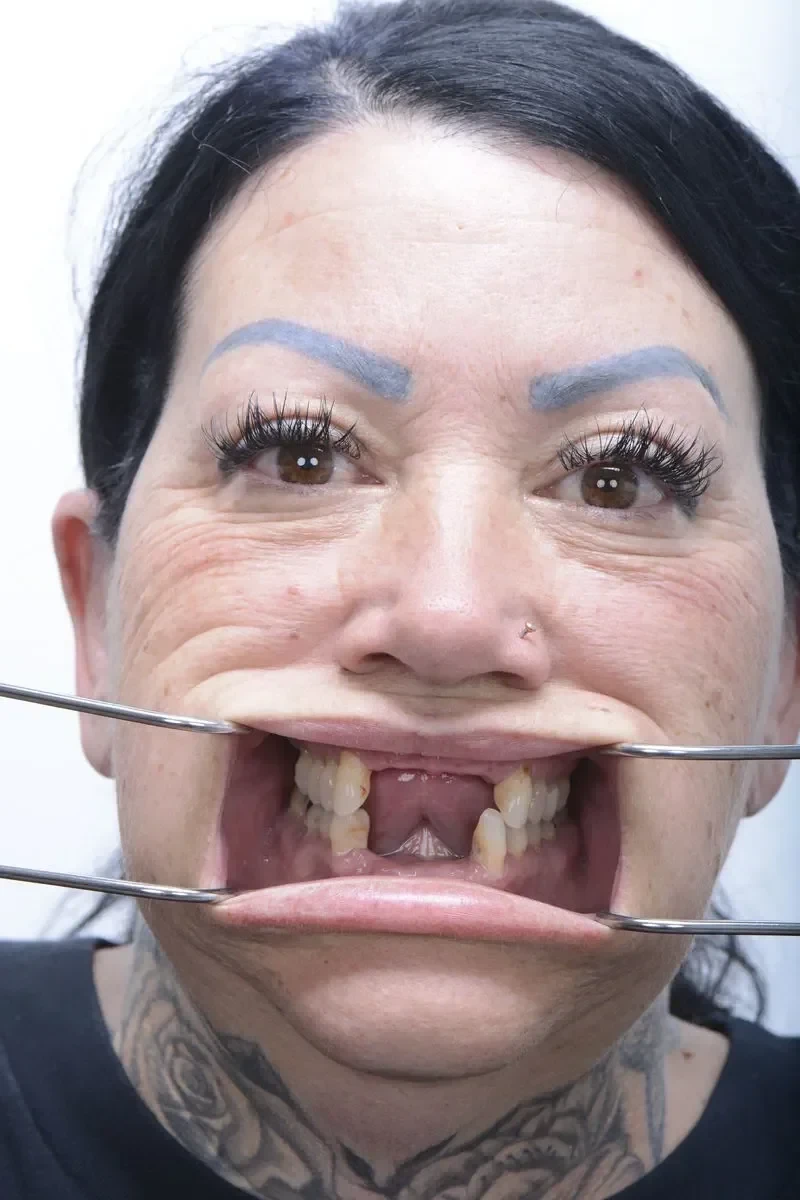 Patient 8 before dental implant surgery at Fusion Dental Implants Roseville