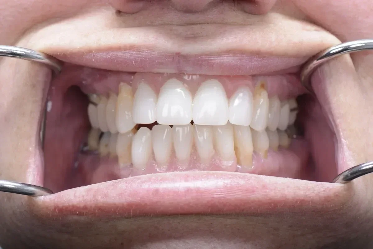 Patient 8 teeth after dental implant surgery