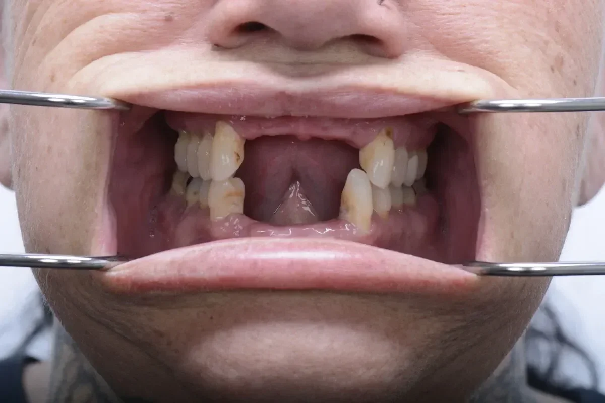 Patient 8 teeth before dental implant surgery